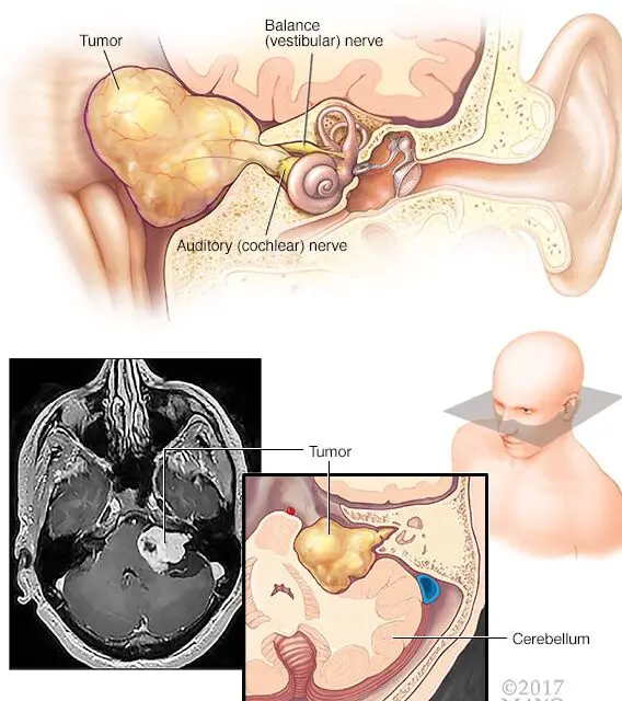 Tumor cerebral - Síntomas y causas - Mayo Clinic